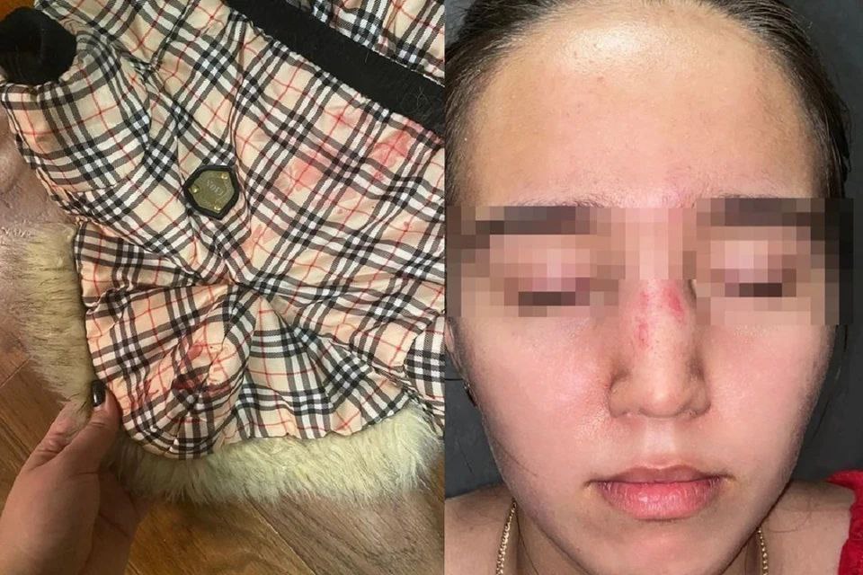 Команда «фас»: в Новосибирске мужчина избил подростка поводком и сломал ей нос