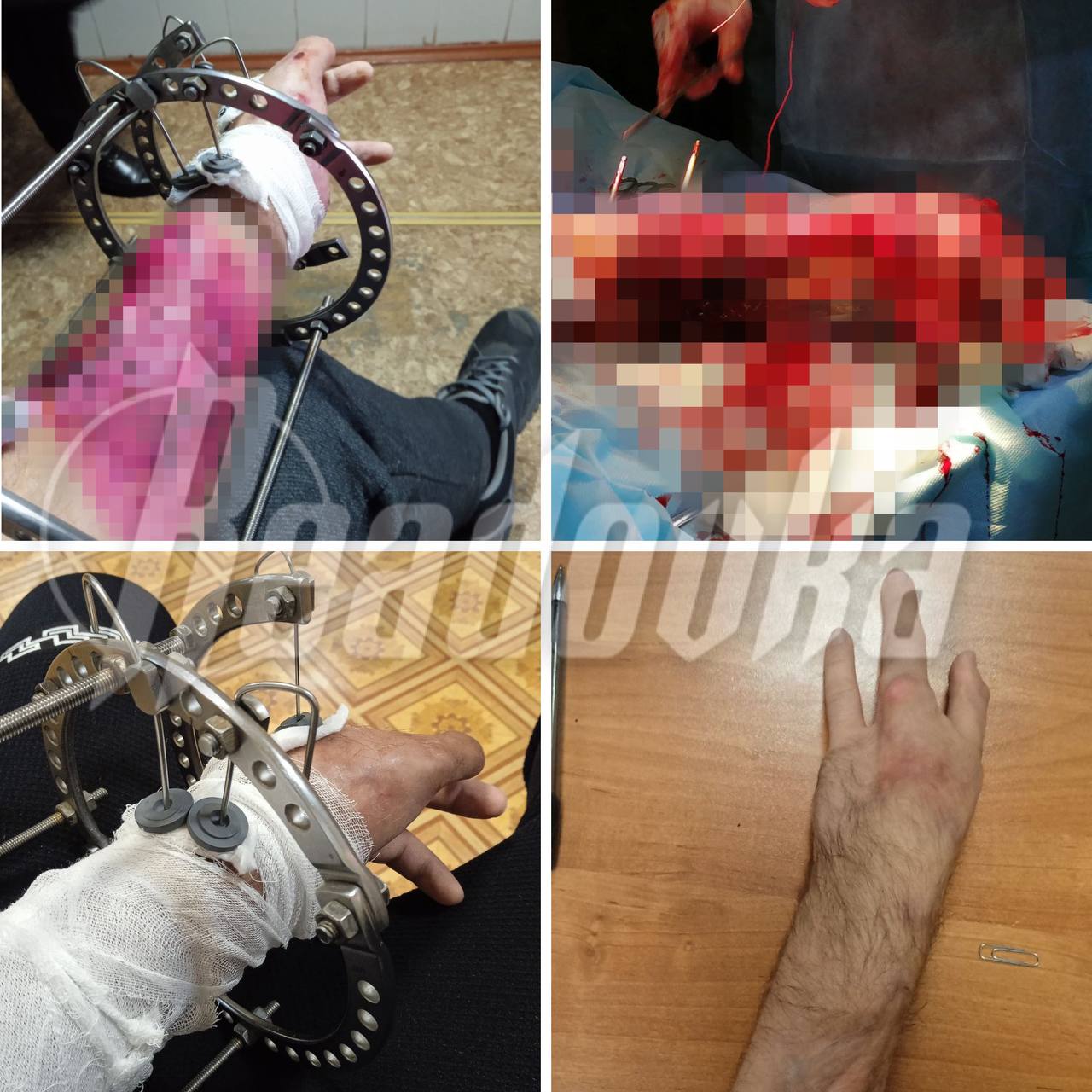 Боец, получивший серьезные ранения во время эвакуации, рассказал, как чудом спасся