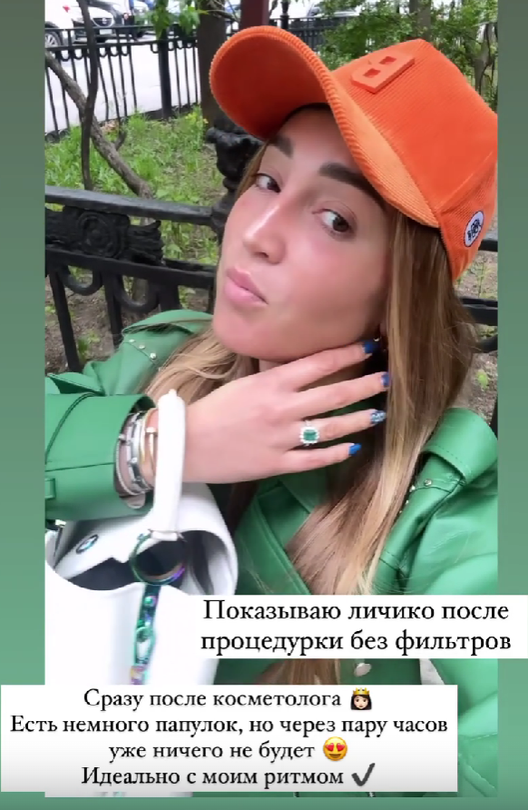 Ольга Бузова показала себя без макияжа и фильтров после похода к косметологу