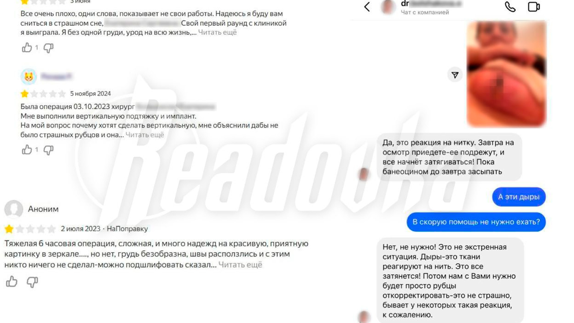 Пациентка челябинской клиники получила некроз тканей после маммопластики. 18+
