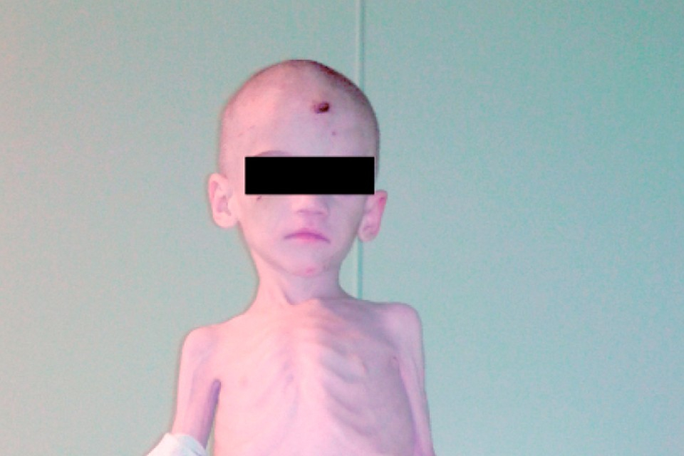 Приемная мать морила сына голодом ради социальных выплат