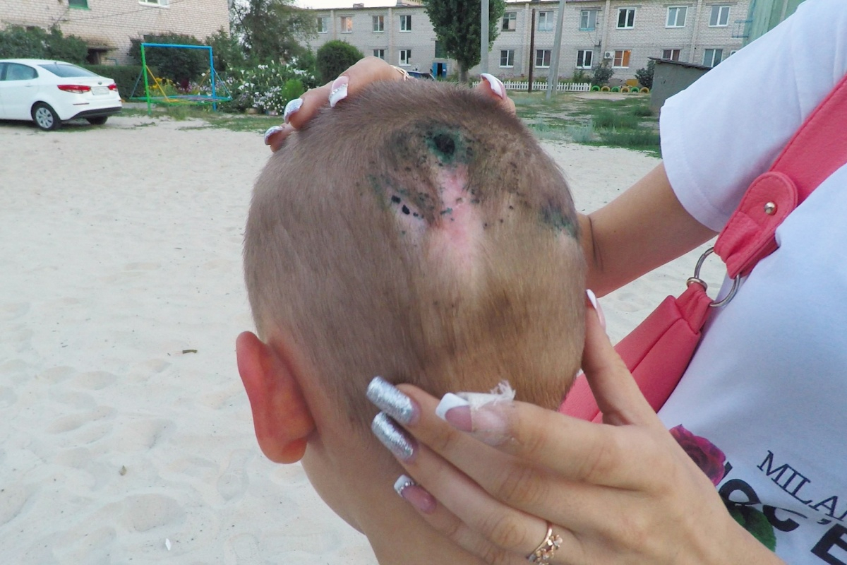 «Мама, я буду жить или умру?»: в Волгограде дворняга накинулась на 8-летнего ребенка