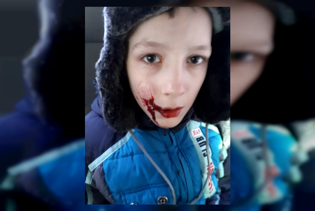 В Братске соседская такса вцепилась ребенку в лицо