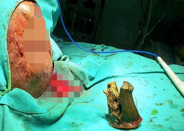 Мужчине на голове удалили “дьявольский рог”