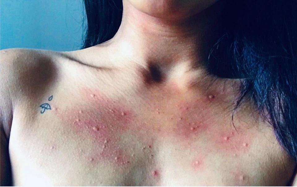 Женщина с аллергией на воду смогла победить недуг с помощью беременности