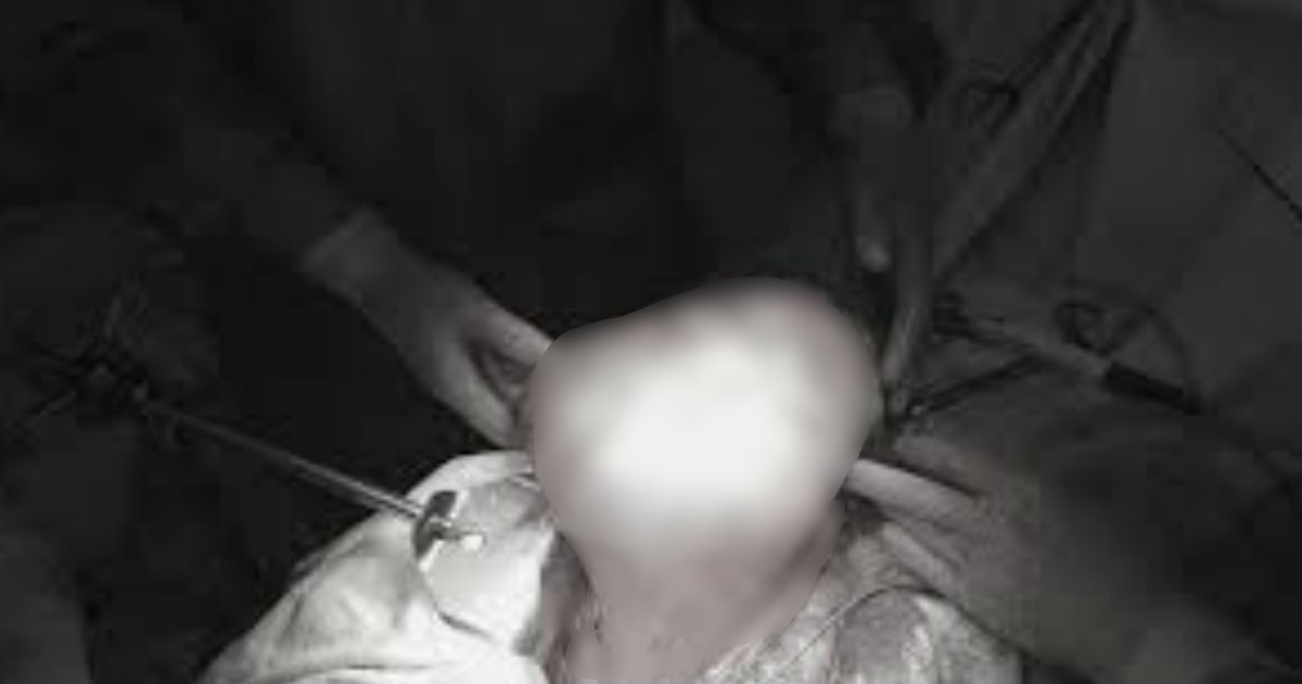 Огромный жировик размером с арбуз привел красноярских врачей в замешательство