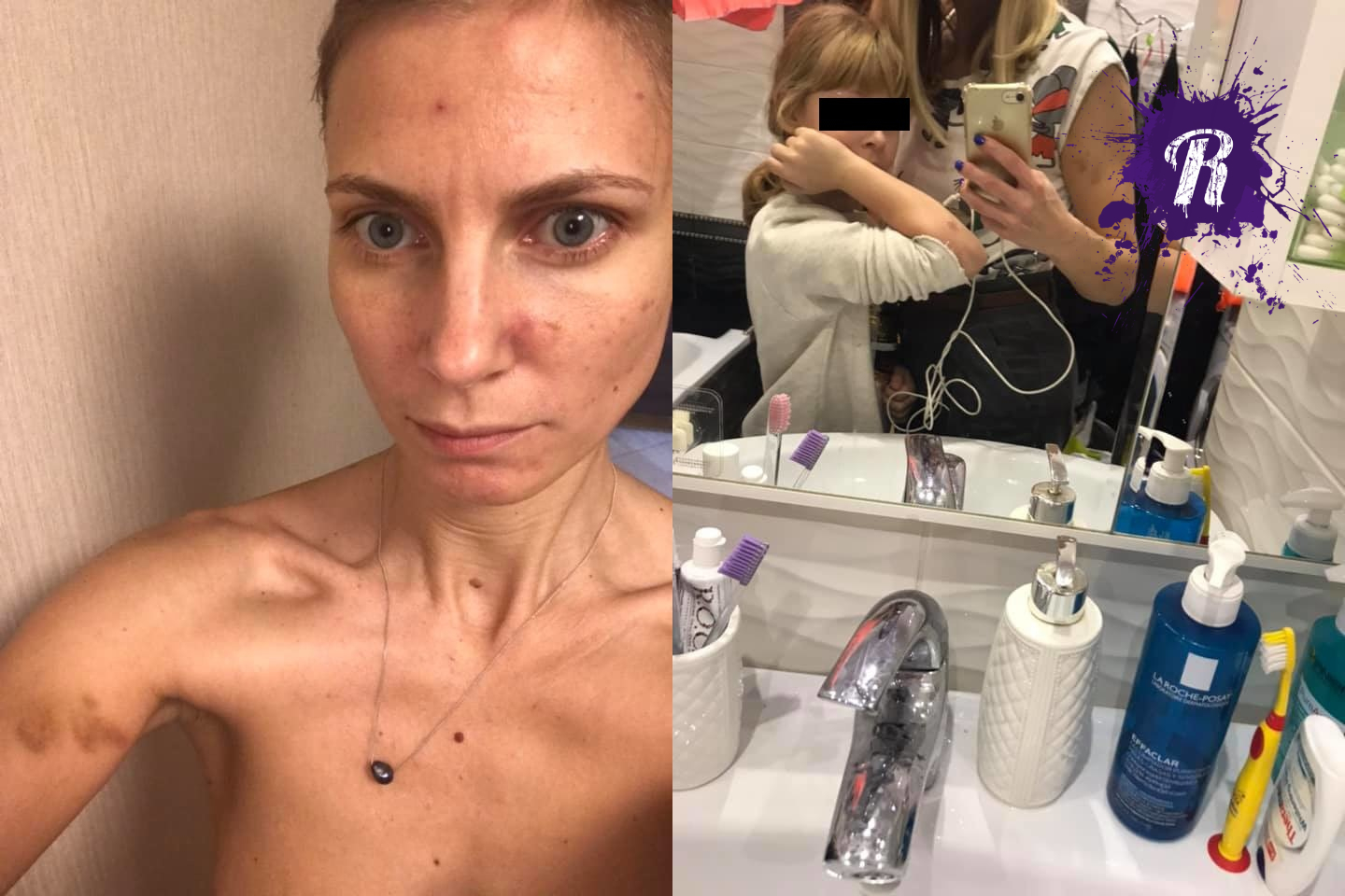 Жертву домашнего насилия оштрафовали за то, что она рассказала о побоях в соцсетях